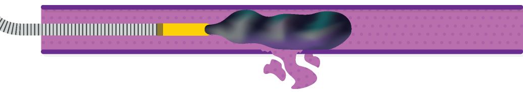 Obsidio Conformable Embolic Plug-like delivery. Coil-like delivery. Distal delivery.