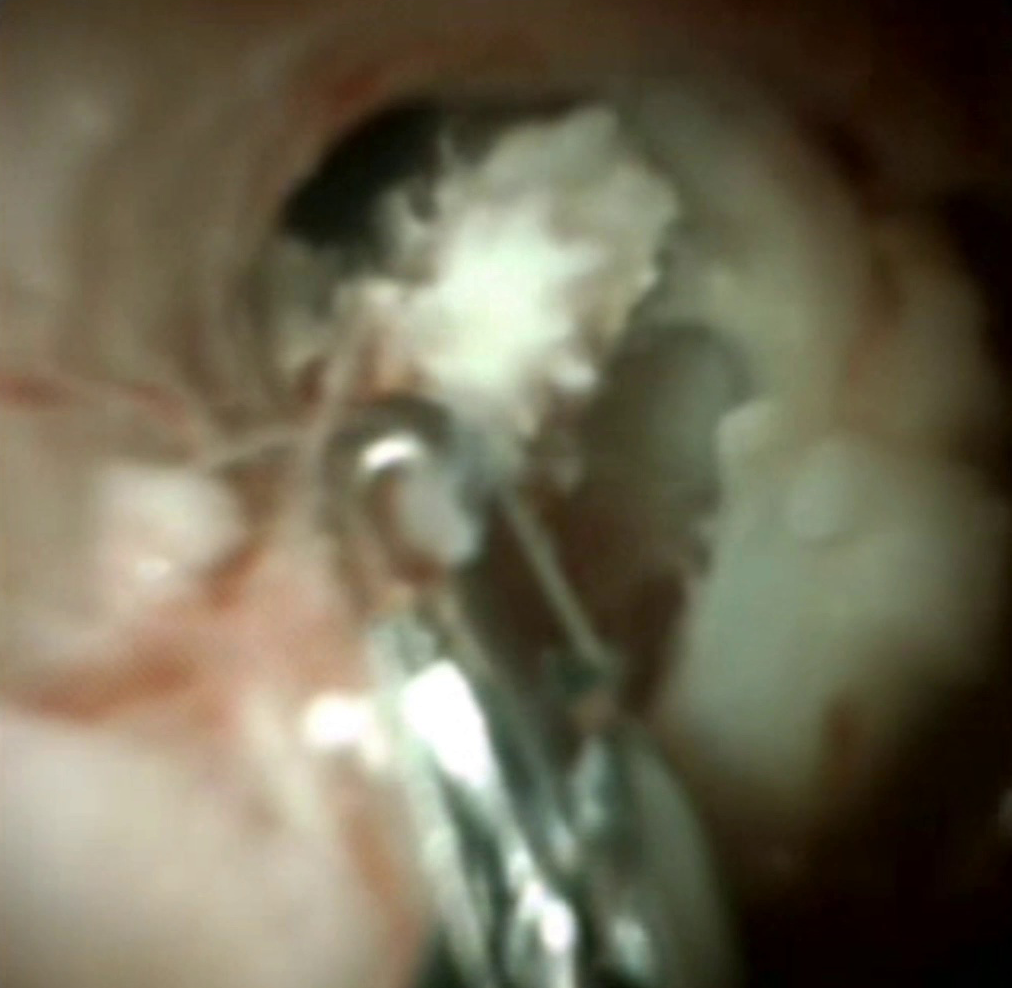 Clinical image of pancreatic duct biopsies.