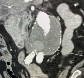 Case Study - Embold™ Type II Endoleak embolized - Boston Scientific