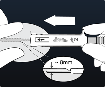 Hands inserting LUX-Dx Insertion Tool into opening 8mm under the skin.