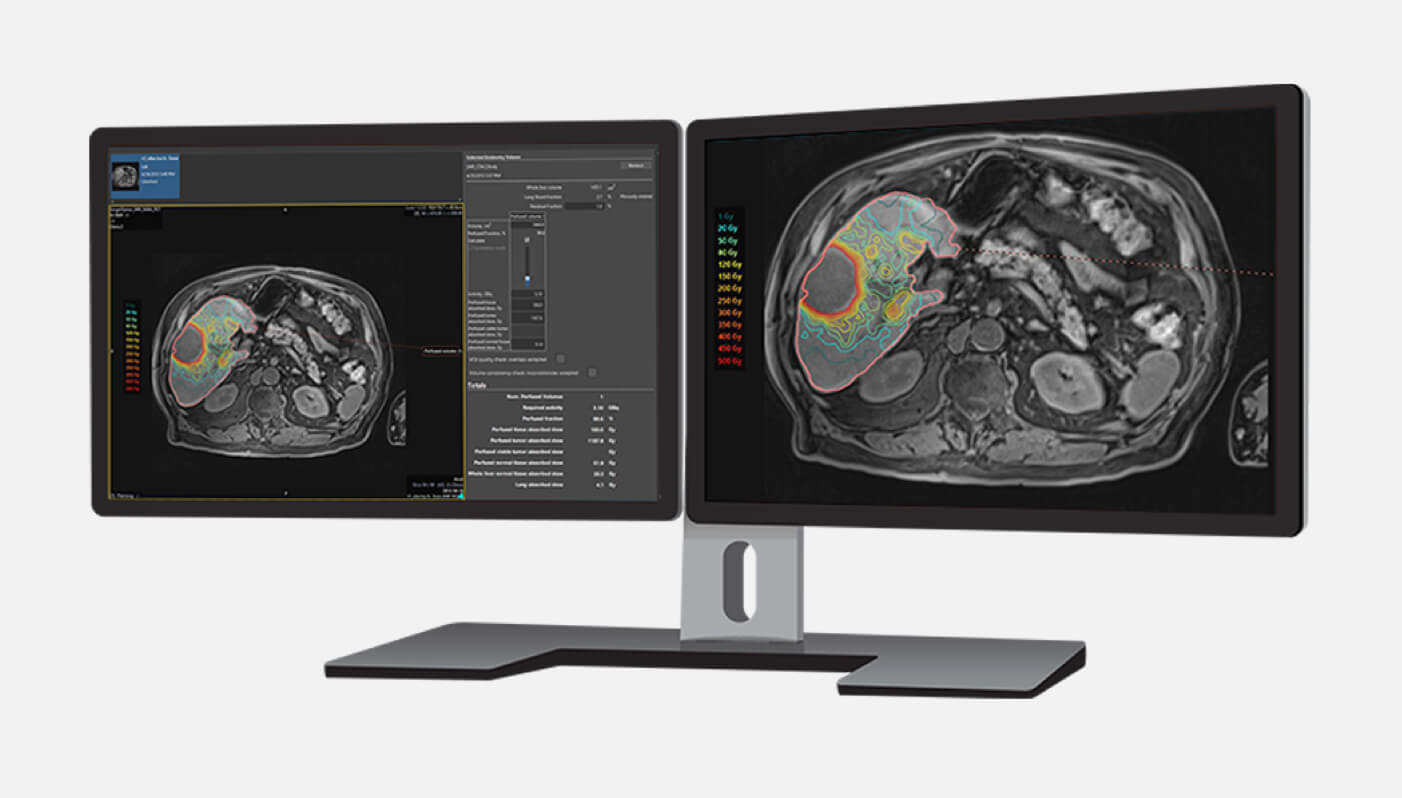 Double desktop monitor showing Simplicit90Y personalized dosimetry software for TheraSphere Y-90 Glass Microspheres.