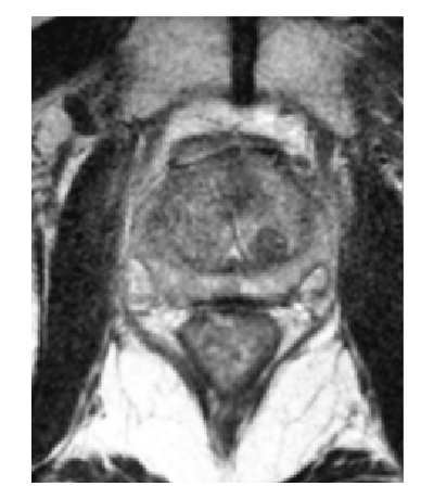 SpaceOAR 12-month absorption scan.