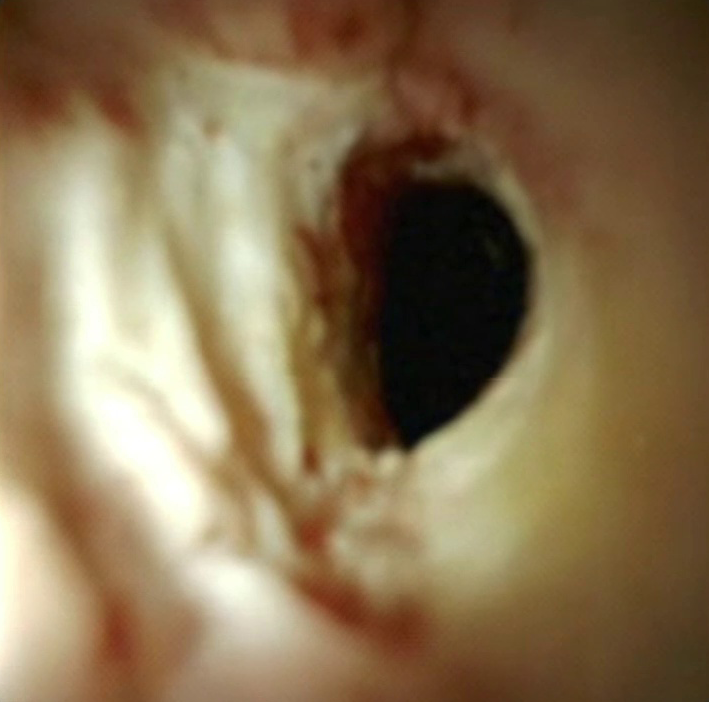 Clinical image of cholangiocarcinoma extension.