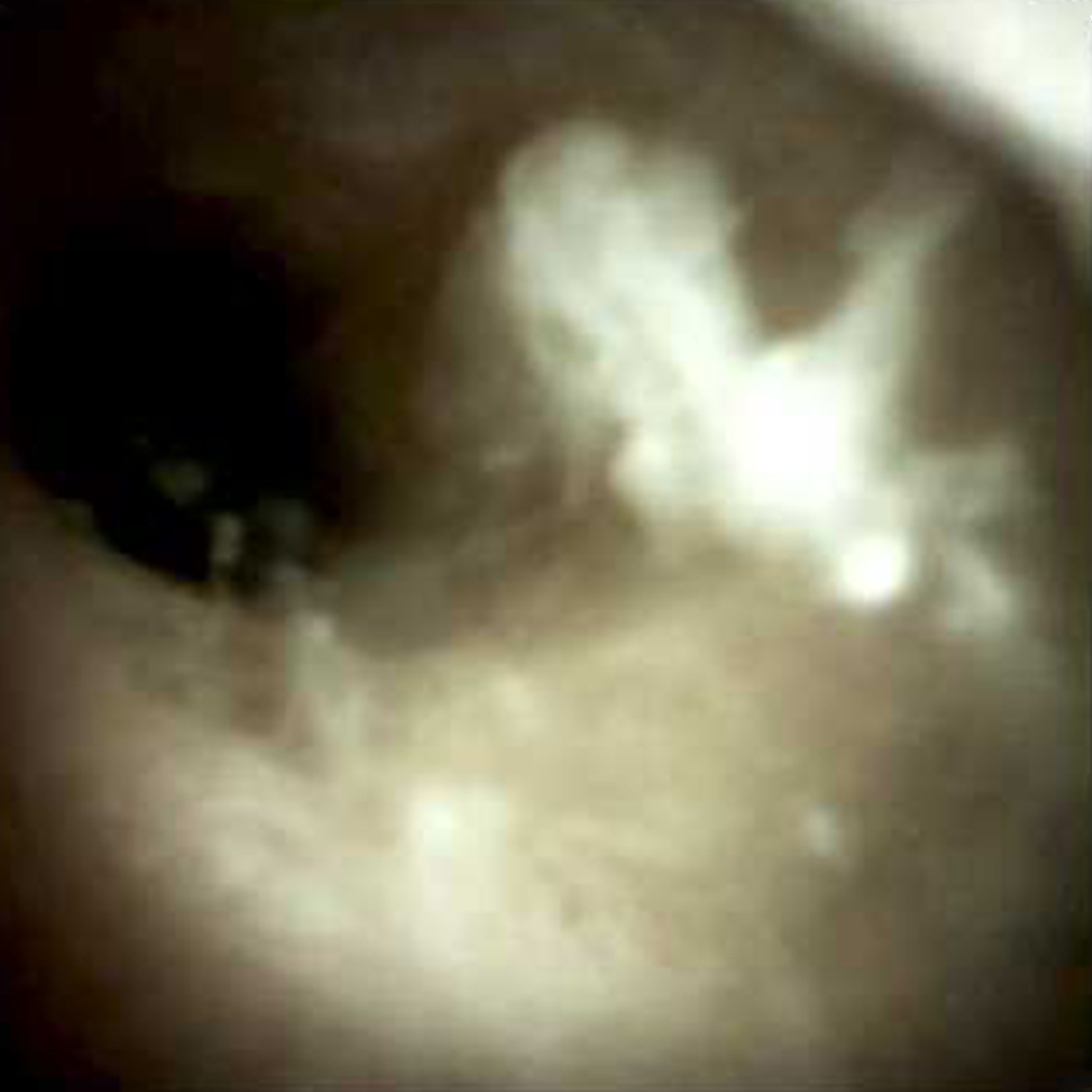 Clinical image of Desquamated epithelium (DS I).