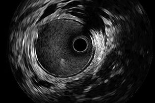 Learn how to IVUS with this simple workflow - Boston Scientific