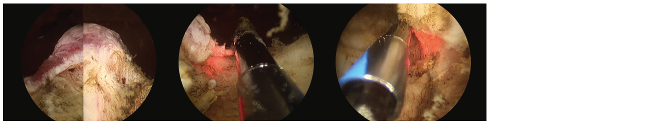 3 scope images. Identifying verumontanum.
