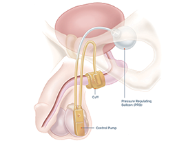 medical diagram of AMS 800 in patient.