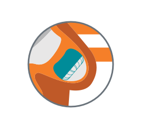 A graphic of a heart depicting the WATCHMAN implant closing off the left atrial appendage.