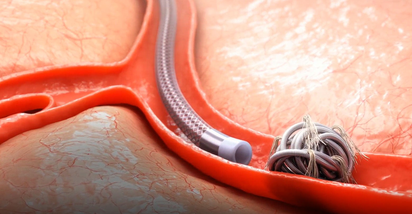 Medical catheter inserted in blood vessel with coil wrapped in a circle.