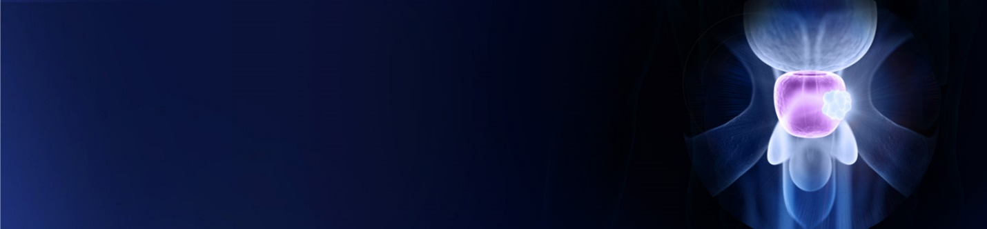 illustration showing prostate with area of cancer.