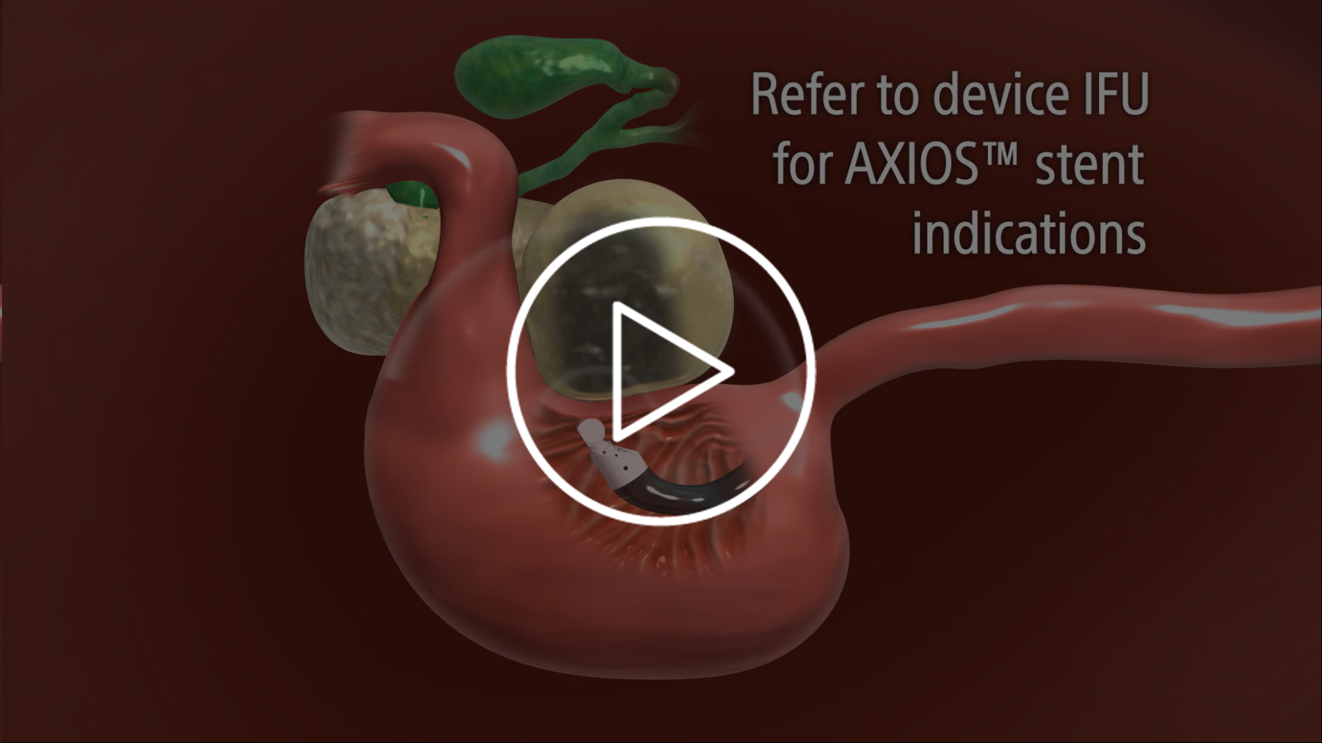 AXIOS™ stent placement with EUS 3D animation.