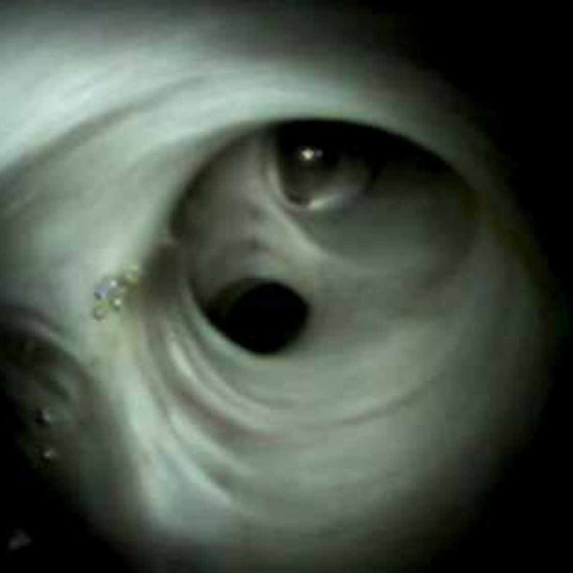 Clinical image of Normal deep right heptic duct (DS I).