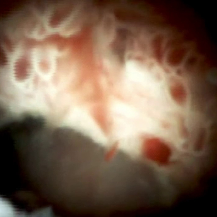Main duct IPMN* prominent villi with blood vessel (SpyScope DS II)