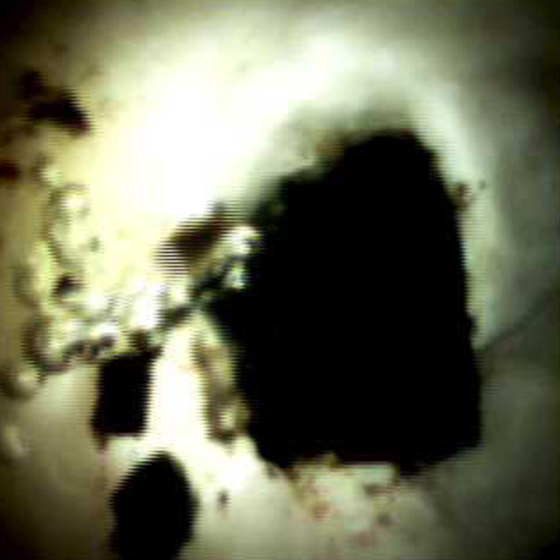 Clinical image of Biliary anastamosis 18 months intrahepatic stones (DS I).