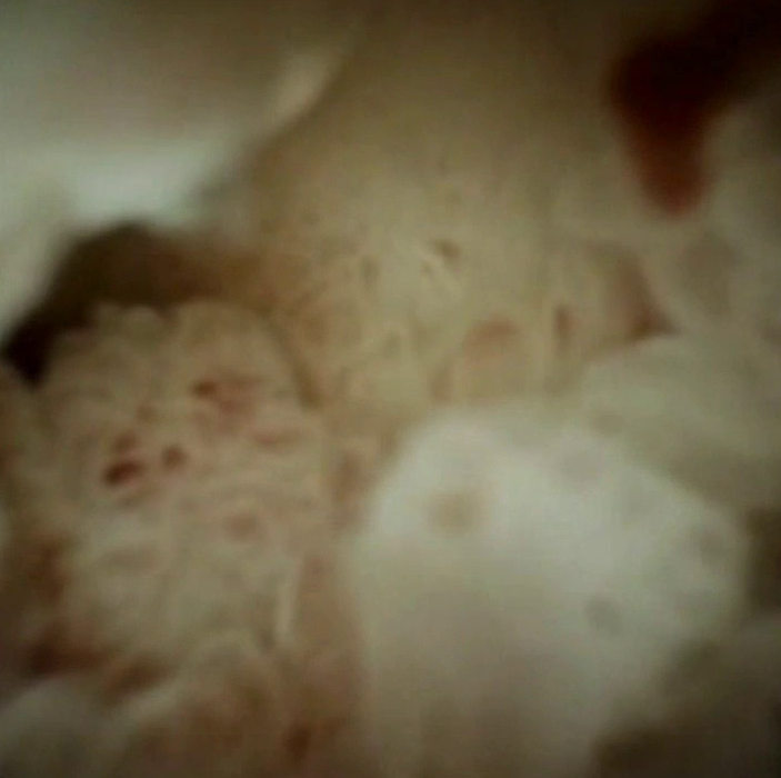 Clinical image of IPMN.