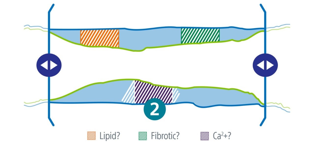 Illustration showing the sideways angle of a lesion and the type of plaque