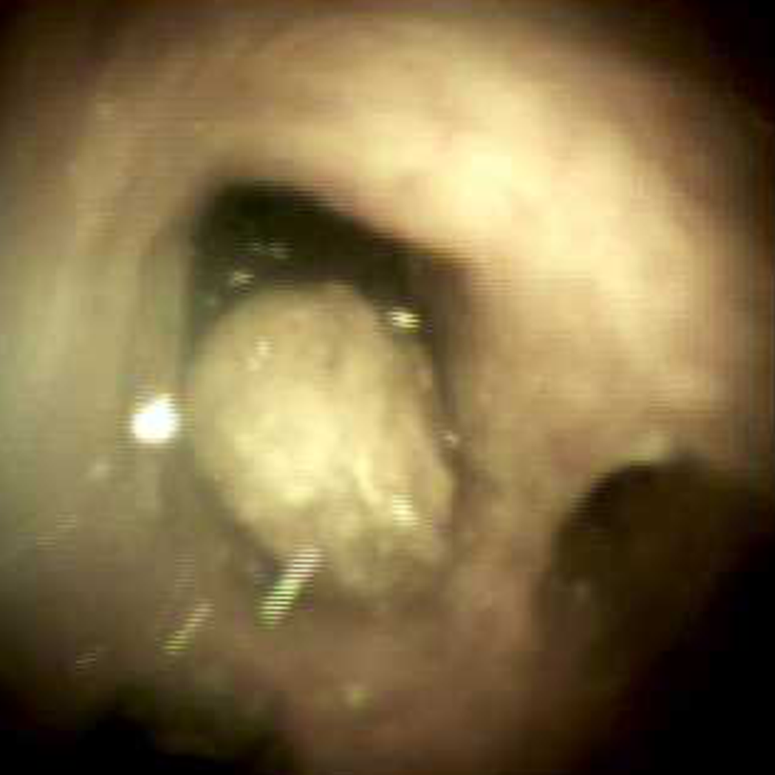Clinical image of intrahepatic stone.