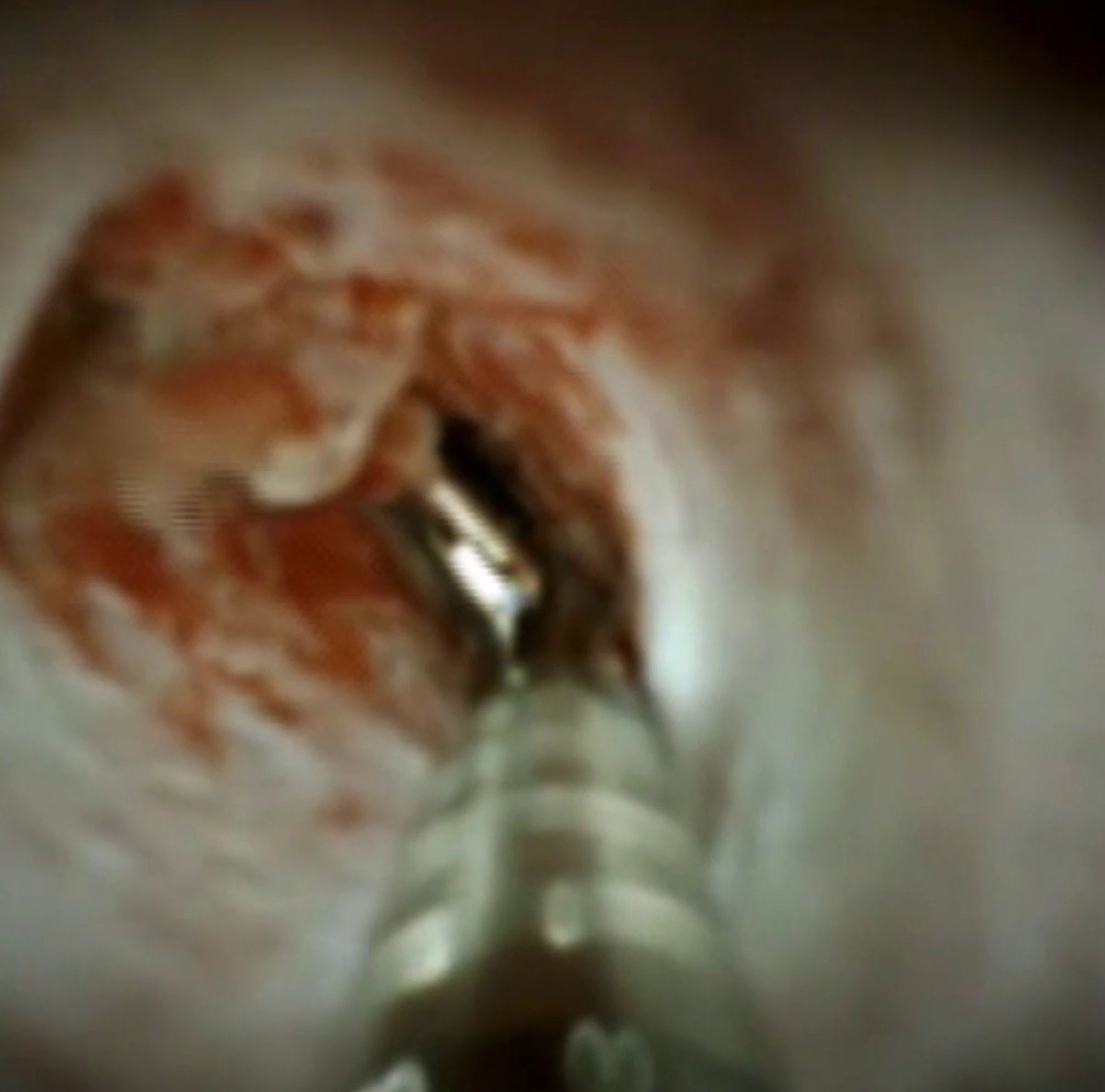 Clinical image of SpyBite (DS II).