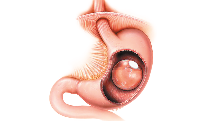 Intragastric-balloons-procedure