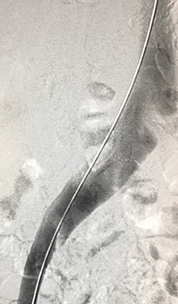 Xray of veins post-ZelanteDVT runtime 415 seconds.