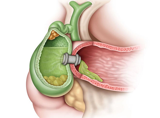 acute chlolecystitis 
