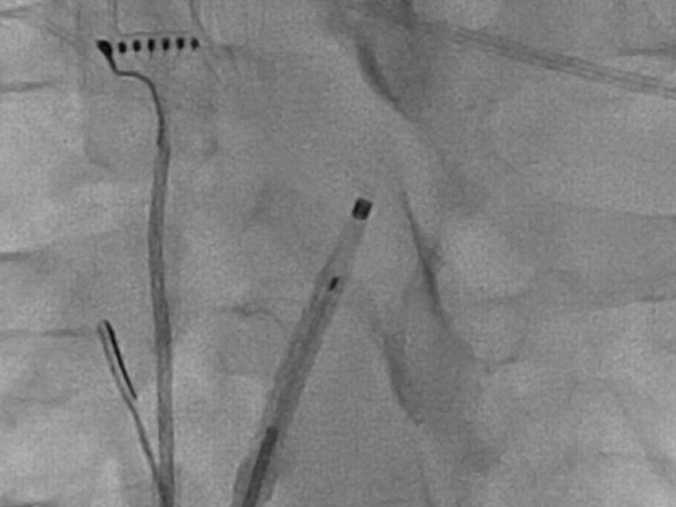 Radiopaque marker of NRG Transseptal Needle during fluoroscopy.