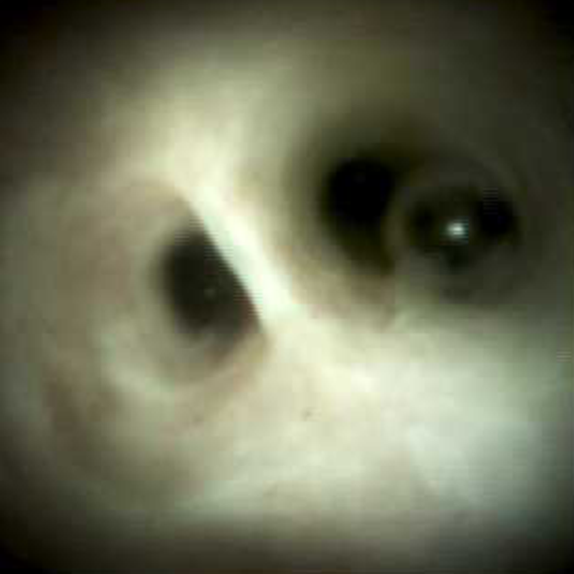 Clinical image of Normal deep left hepatic duct (DS I).