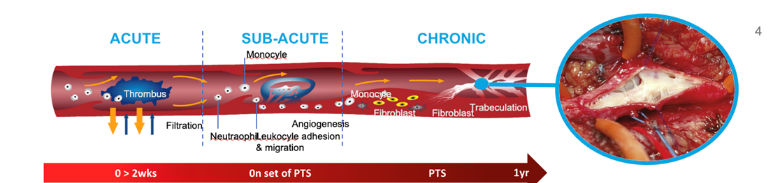 Image shows a timeline for acute, subacute and chronic DVT, from 0-2 weeks to a year.