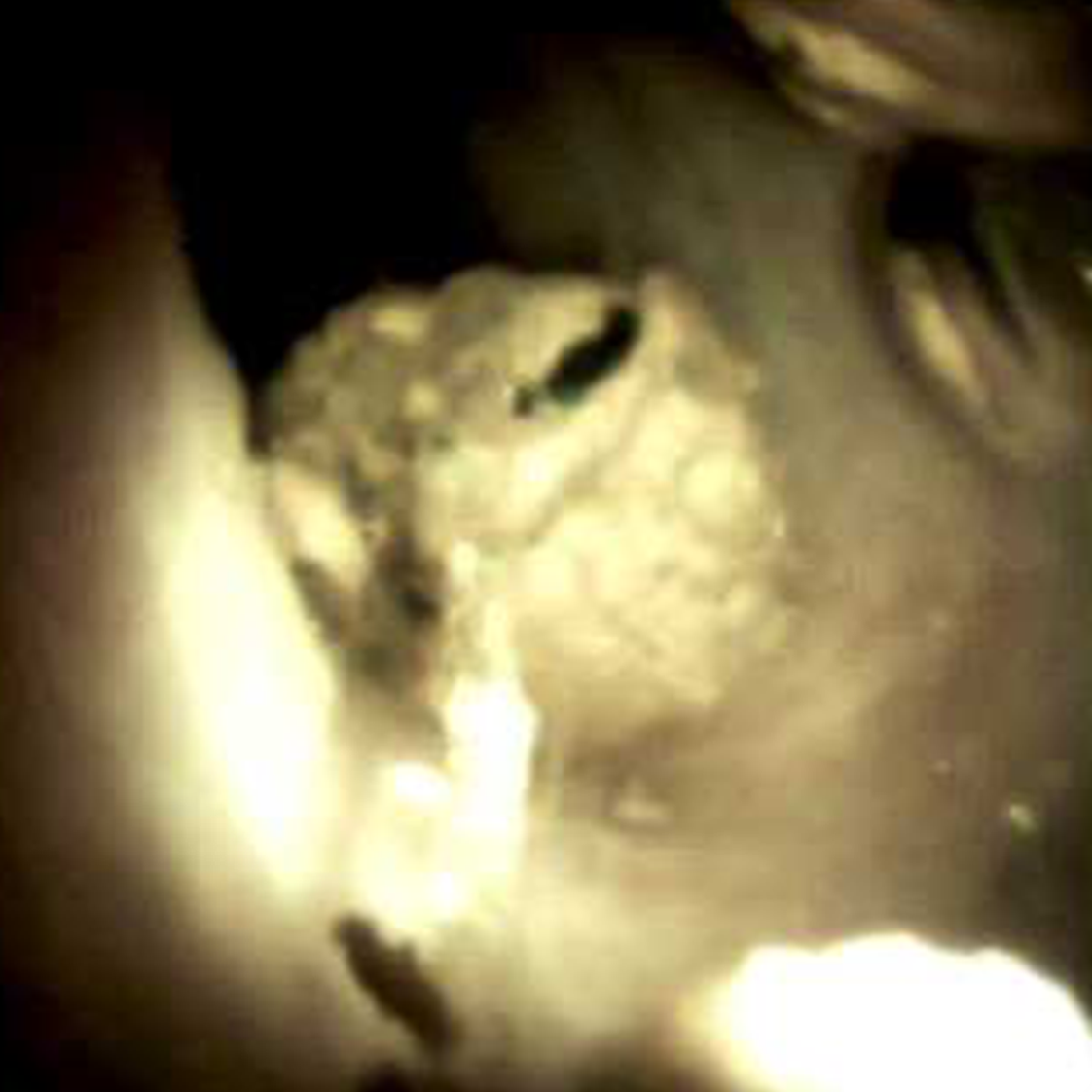 Clinical image of cystic duct stone.
