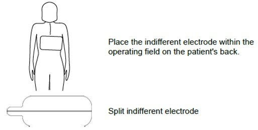 Place the indifferent electrode within the operating field on the patient's back. Illustration of placement.