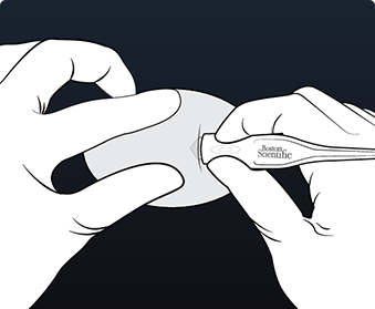 Hands wearing surgical gloves creating incision with LUX-Dx Incision Tool.