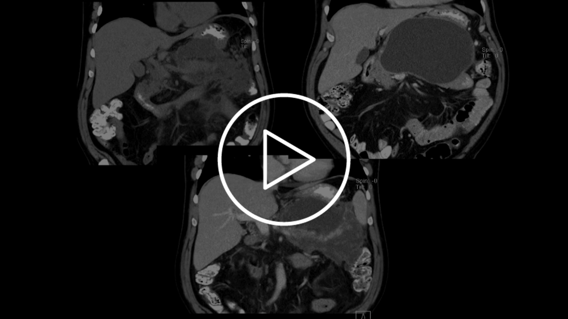 AXIOS™ stent device in-service demonstration.