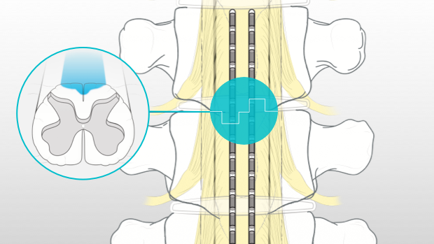 Illustration of spinal cord stimulation therapy and lead placement.