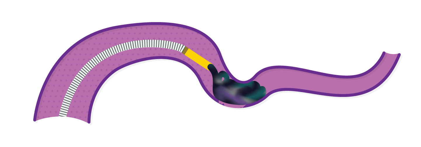 Obsidio conformable slow injection deployment end delivery.