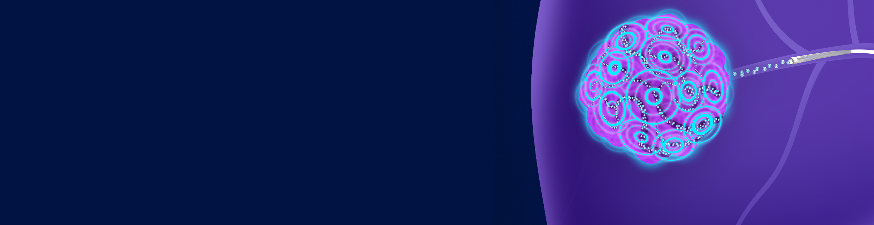 TheraSphere Y-90 Glass Microspheres being administered to treat HCC.