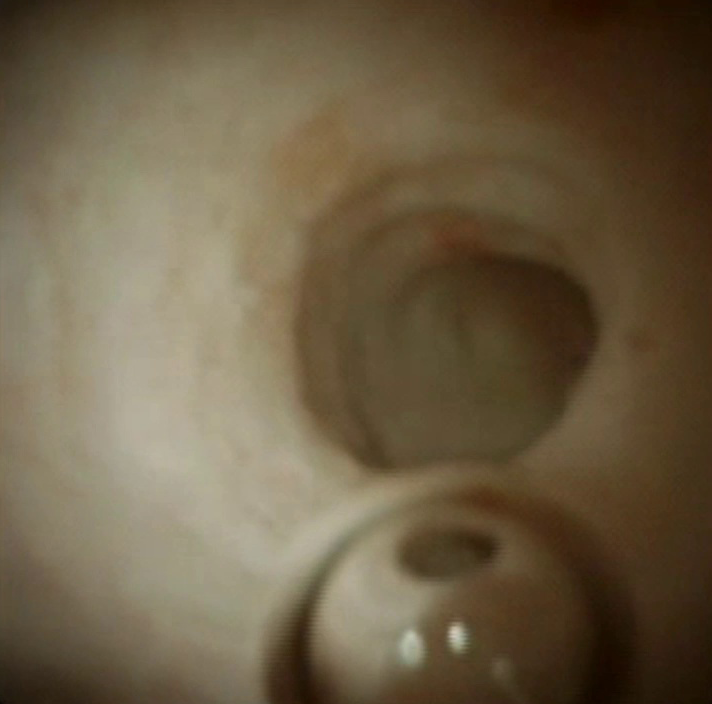 Clinical image of pancreatic duct.