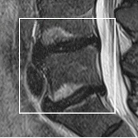 Lumbar spine MRI showing Modic changes within the highlighted vertebral region.