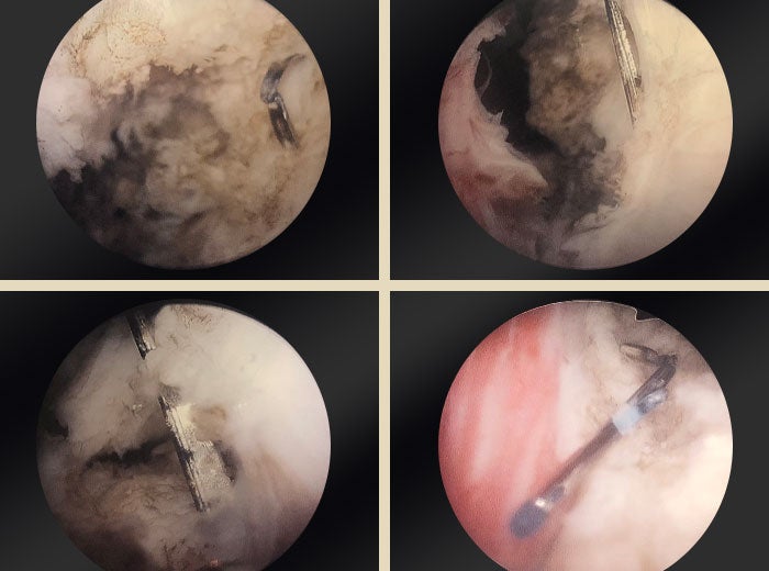 4 individual shots of an OR camera zoomed into prostate.