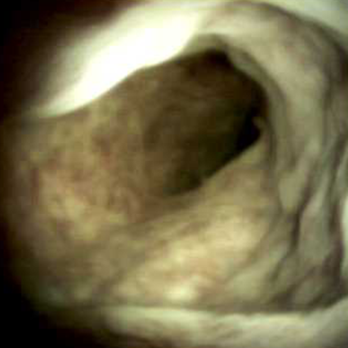 Clinical image of Portal vein thrombosis and cholangiopathy (DS I).