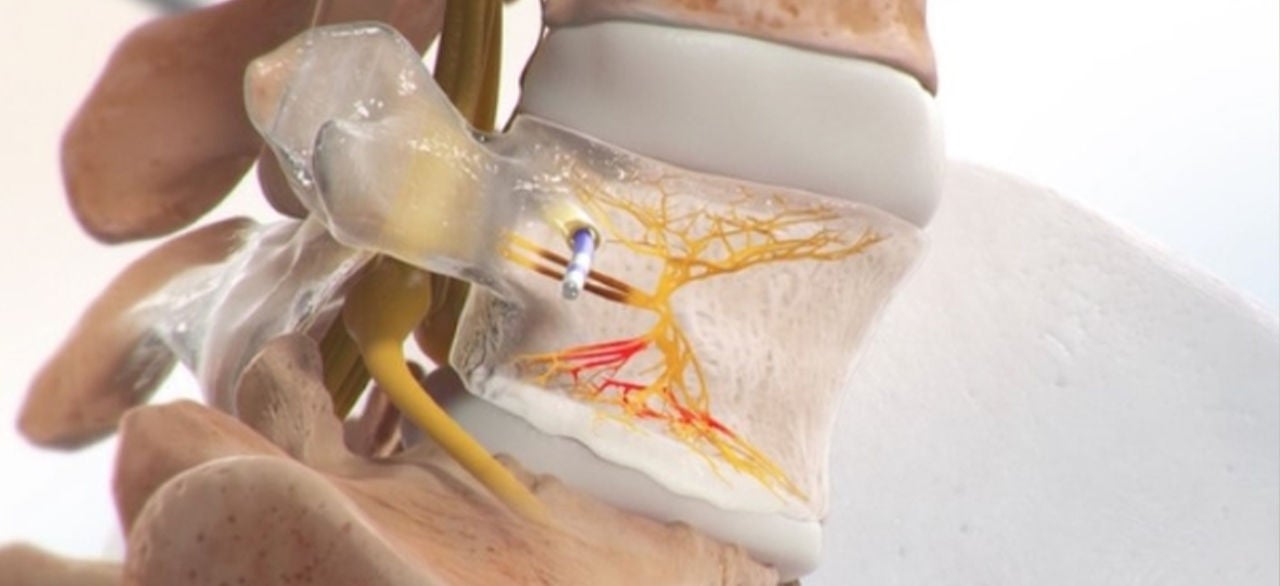 Close-up view of a medical spine model highlights a transparent vertebra with visible nerve pathways.