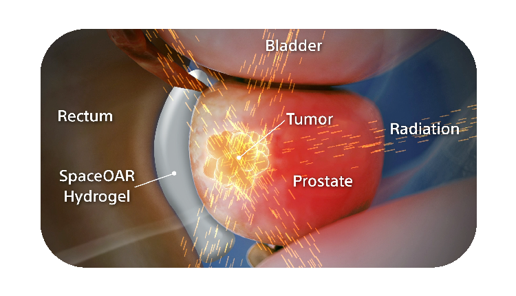 With hydrogel radiation.
