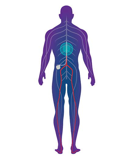 Illustration of spinal cord stimulation pathways from upper back to both legs.