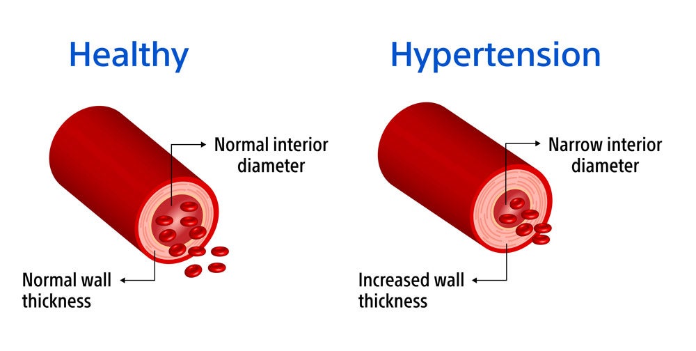 Illustration of healthy and hypertension vessels. 