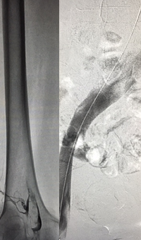 Xray of Iliofemoral thrombus pre-treatment and Power Pulse™ delivery