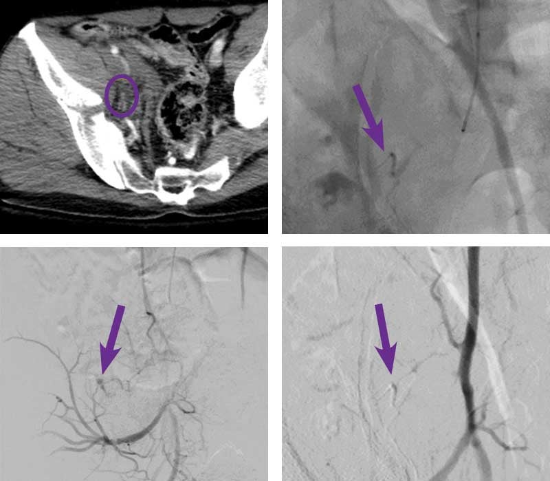 Scan images from Obsidio right internal iliac artery embolization case.