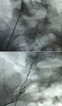 Xray of pre-treatment.
