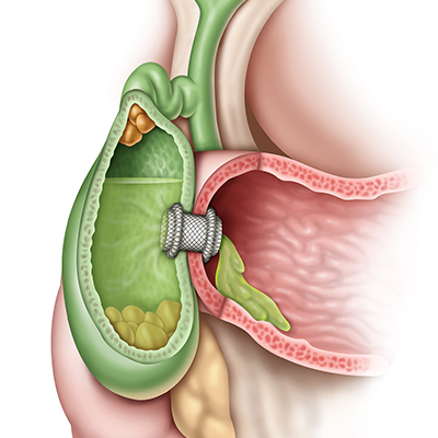 Autotome™ Pro RX Cannulating Sphincterotome product detail.