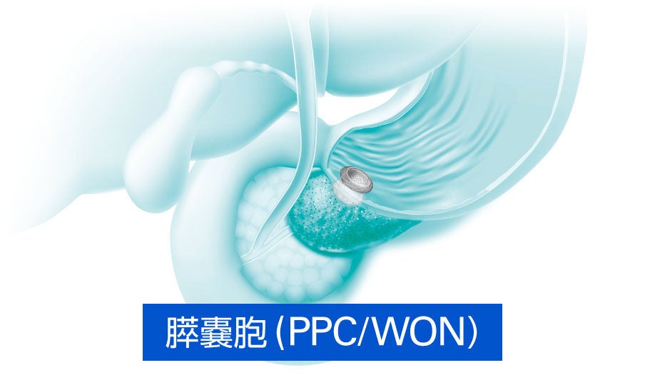 膵臓ドレナージ