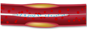 A scientific drawing of AGENT DCB in a vessel illustrating targeted transfer. 