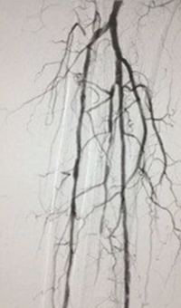 Case CLI with Right Foot Ulcer Thrombectomy post-procedure arteriogram.